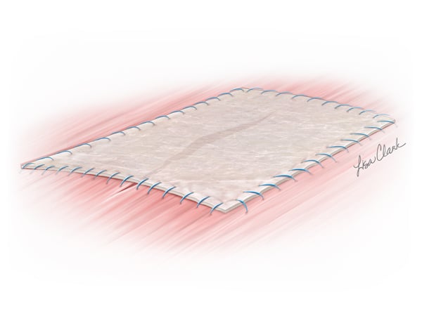 Biodesign 4-Layer Tissue Graft