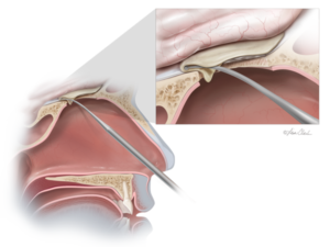 Biodesign Duraplasty Graft