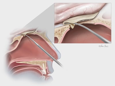 Biodesign<sup>®</sup> Duraplasty Graft