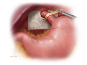 Biodesign Hiatal Hernia Graft