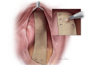 Biodesign Rectoplexy Graft