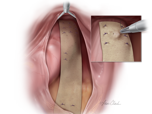 Biodesign Rectoplexy Graft