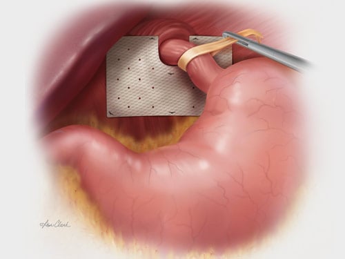 Biodesign<sup>®</sup> Hiatal Hernia Graft