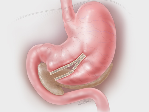 Biodesign<sup>®</sup> Staple Line Reinforcement (gastric, colon, colorectal indication)
