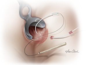 Biodesign Anal Fistula Plug Set