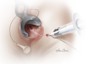 Biodesign Fistula Plug Set