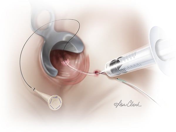 Biodesign Fistula Plug Set