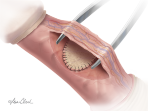 Biodesign Peyronies Repair Graft