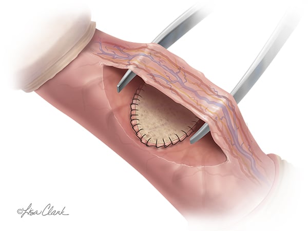 Biodesign Peyronies Repair Graft