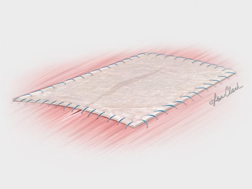 Biodesign<sup>®</sup> 4-Layer Tissue Graft