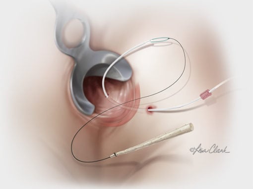 Biodesign<sup>®</sup> Anal Fistula Plug Set