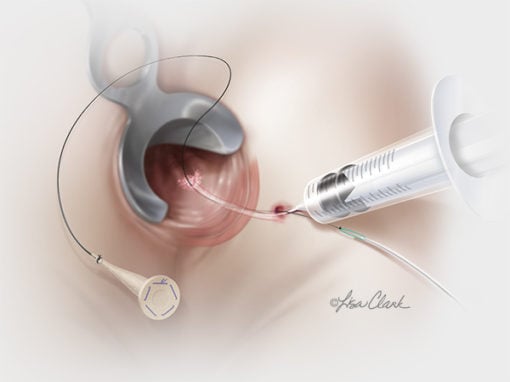 Biodesign<sup>®</sup> Fistula Plug Set