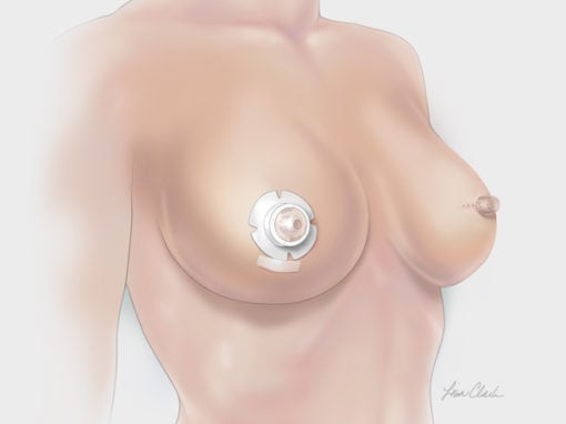 HaloShield<sup>®</sup> Nipple Protector