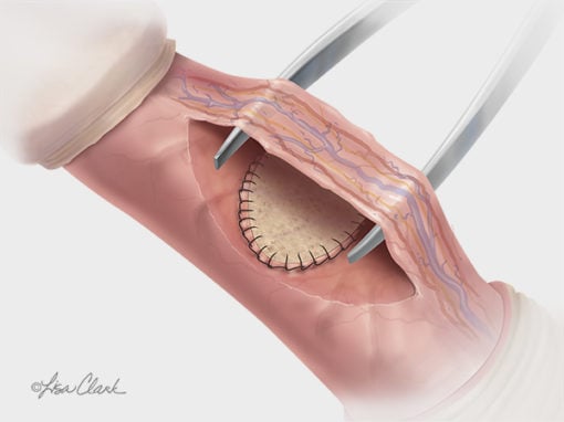 Biodesign<sup>®</sup> Peyronie’s Repair Graft