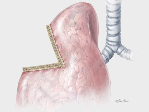 Biodesign<sup>®</sup> Staple Line Reinforcement  (lung resection indication)