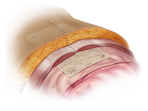 Biodesign® Hernia Graft