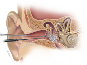 Biodesign® Otologic Repair Graft