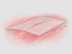 Biodesign® 1-Layer Tissue Graft