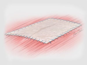 Biodesign® 4-Layer Tissue Graft