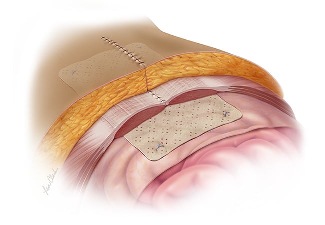 Biodesign® Hernia Graft Biodesign® Hernia Graft