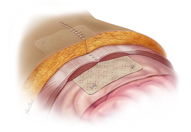 Biodesign® Hernia Graft