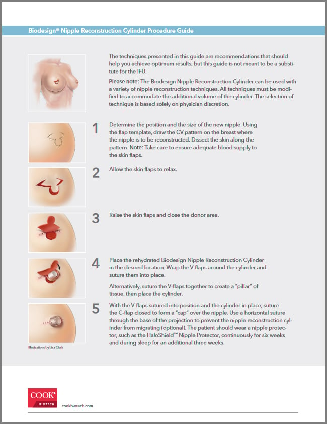 Biodesign Nipple Reconstruction Cylinder Procedure Guide