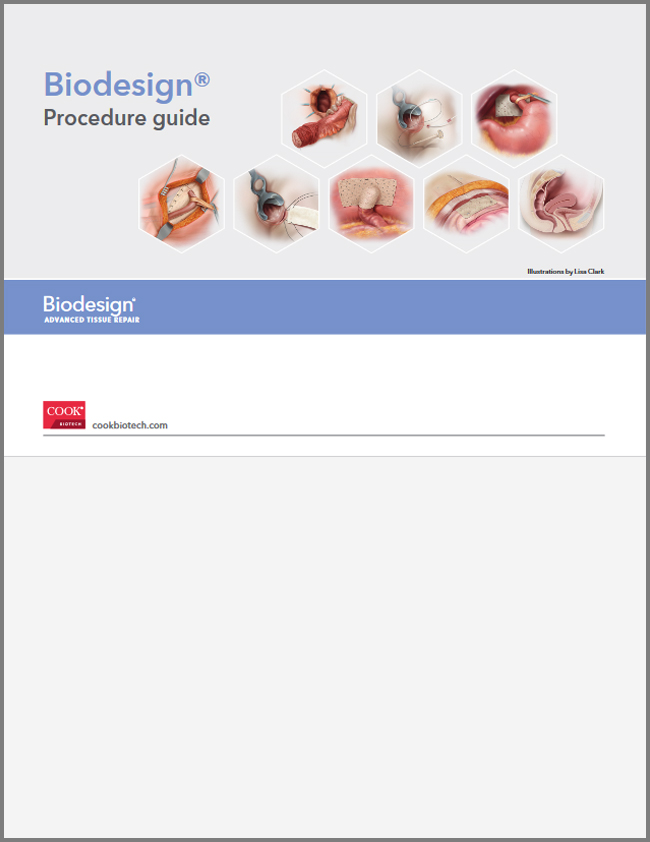 Biodesign Surgical Procedure Guide