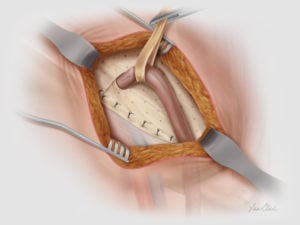 Biodesign® Inguinal Hernia Graft