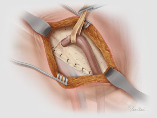 Biodesign<sup>®</sup> Inguinal Hernia Graft