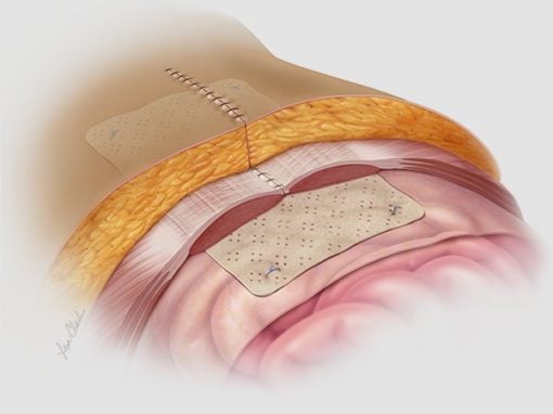 Biodesign<sup>®</sup> Hernia Graft