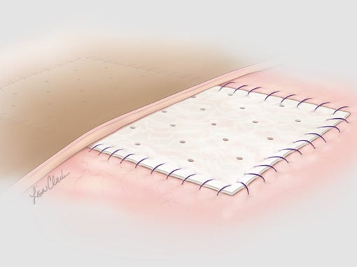 Biodesign<sup>®</sup> Plastic Surgery Matrix